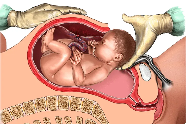 Cesarean section