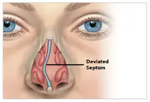 Deviated Nasal Septum