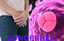 GONORRHEA