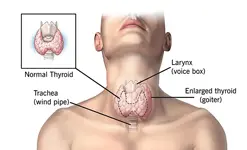 Goiter Surgery