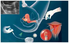 IUI Procedure