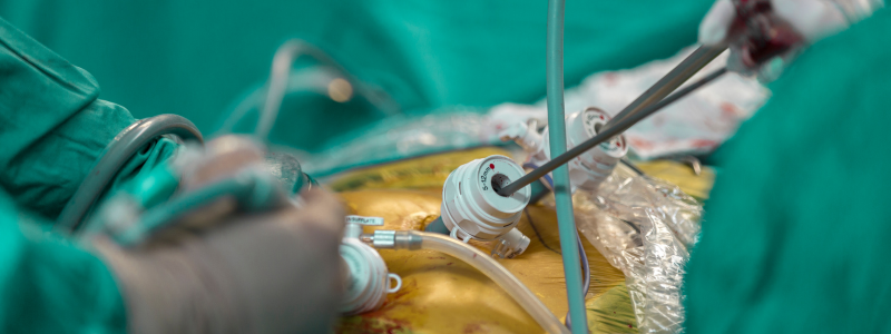 Laparoscopic Surgery