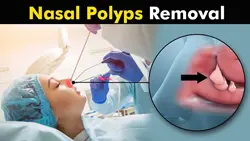 Nasal Polyps