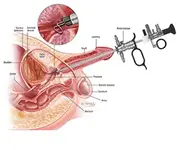 TURP for Prostate Enlargement