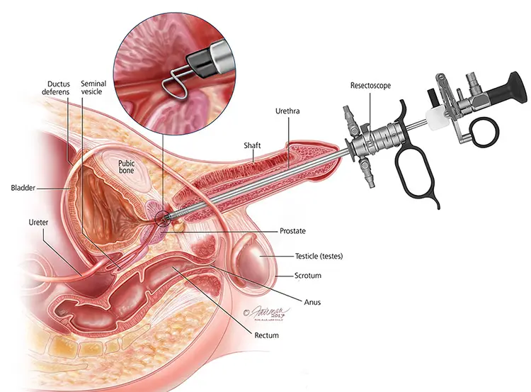 TURP for Prostate Enlargement