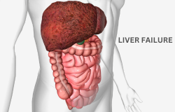 Understanding Liver Failure: Causes, Symptoms, and Treatment Options