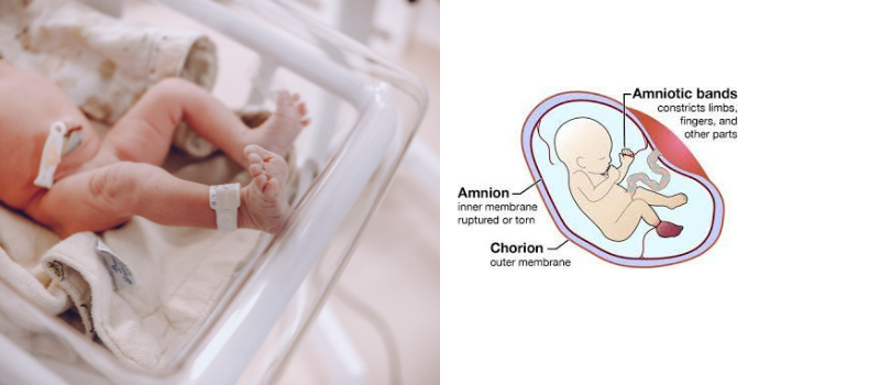 Understanding Amniotic Band Syndrome: A Complex Web of Challenges