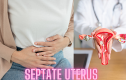 Understanding Septate Uterus: Causes, Symptoms, and Treatment Options