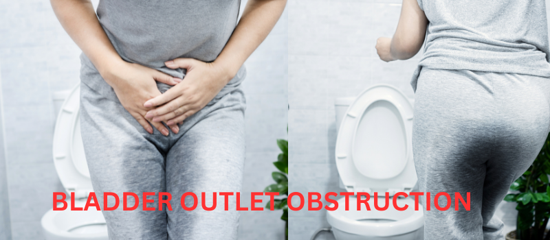 Understanding Bladder Outlet Obstruction: Causes, Symptoms, and Treatment Options