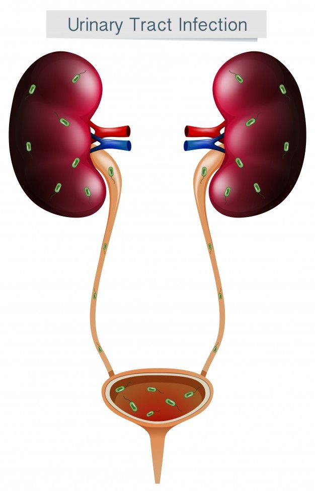 Understanding Urinary Tract Infections (UTIs): Symptoms, Causes, and Prevention