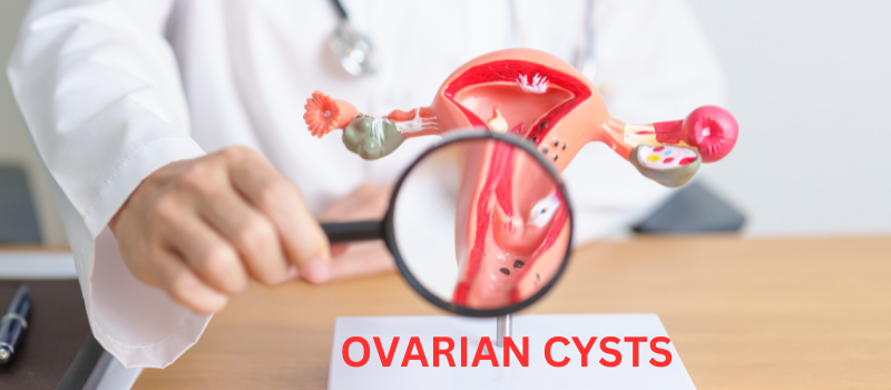  Understanding Ovarian Cysts: Causes, Symptoms, and Treatment Options