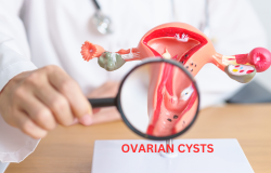 Understanding Ovarian Cysts: Causes, Symptoms, and Treatment Options