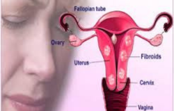 Understanding Uterine Fibroids: Symptoms, Causes, and Treatment Options