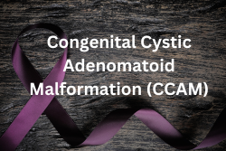  Understanding Congenital Cystic Adenomatoid Malformation (CCAM): A Complex Condition Explained