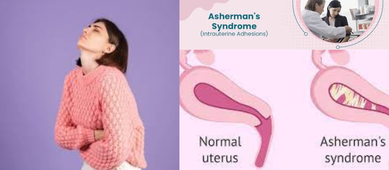  Unraveling the Enigma of Intrauterine Adhesions: A Deep Dive into Asherman's Syndrome