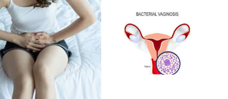  Unveiling the Veil of Bacterial Vaginosis: Understanding, Treatment, and Prevention